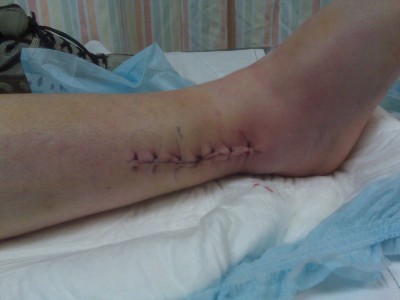 Outside stitches