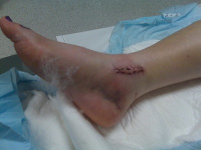 Inside stitches