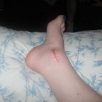 ankle_0001
