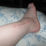 ankle_0002
