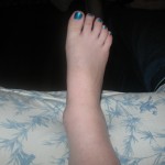 ankle_0003