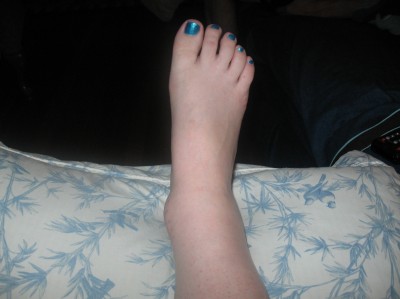 ankle_0003
